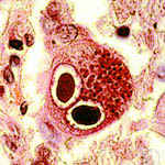 цитомегаловирус