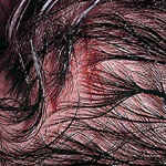 гонококковый абсцесс волосистой части головы