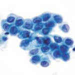 атипичные клетки плоского
эпителия